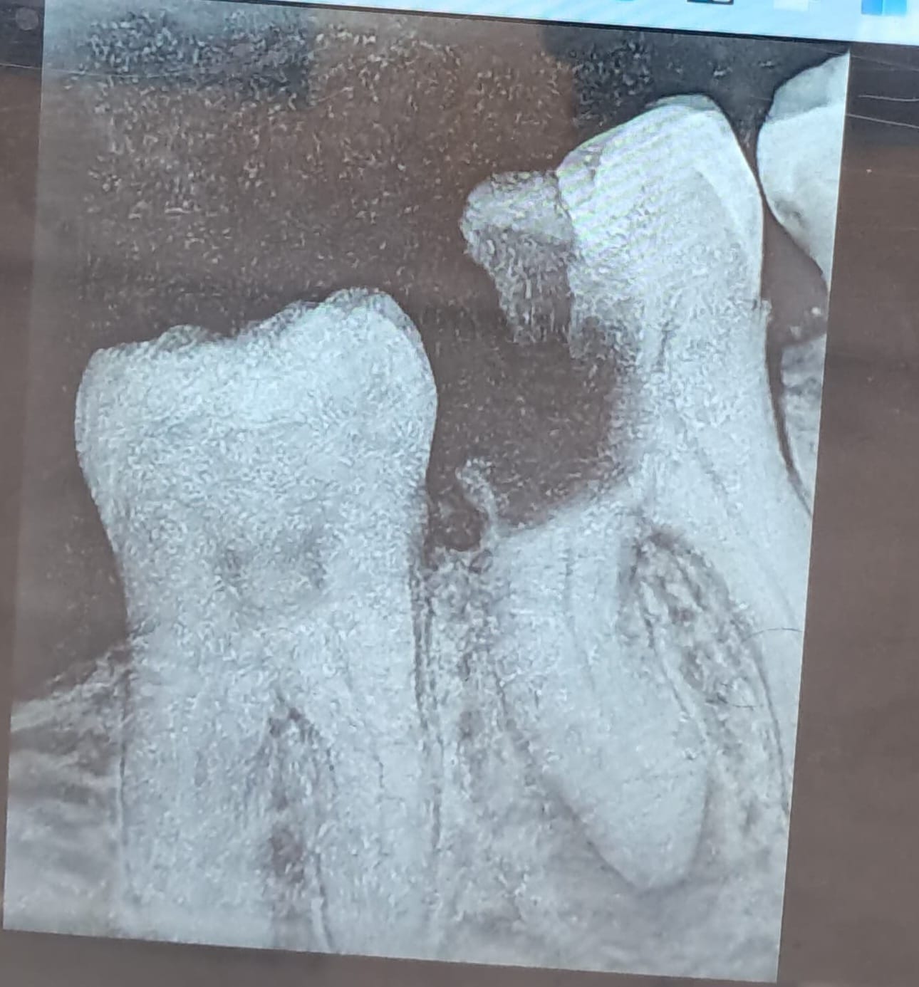 Intraoral Camera View