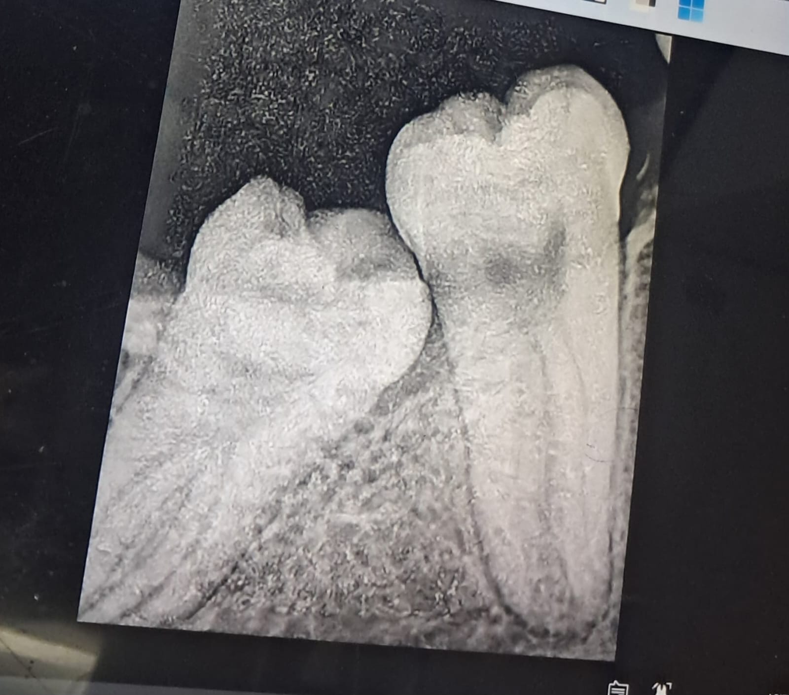 Dental X-ray of Molars