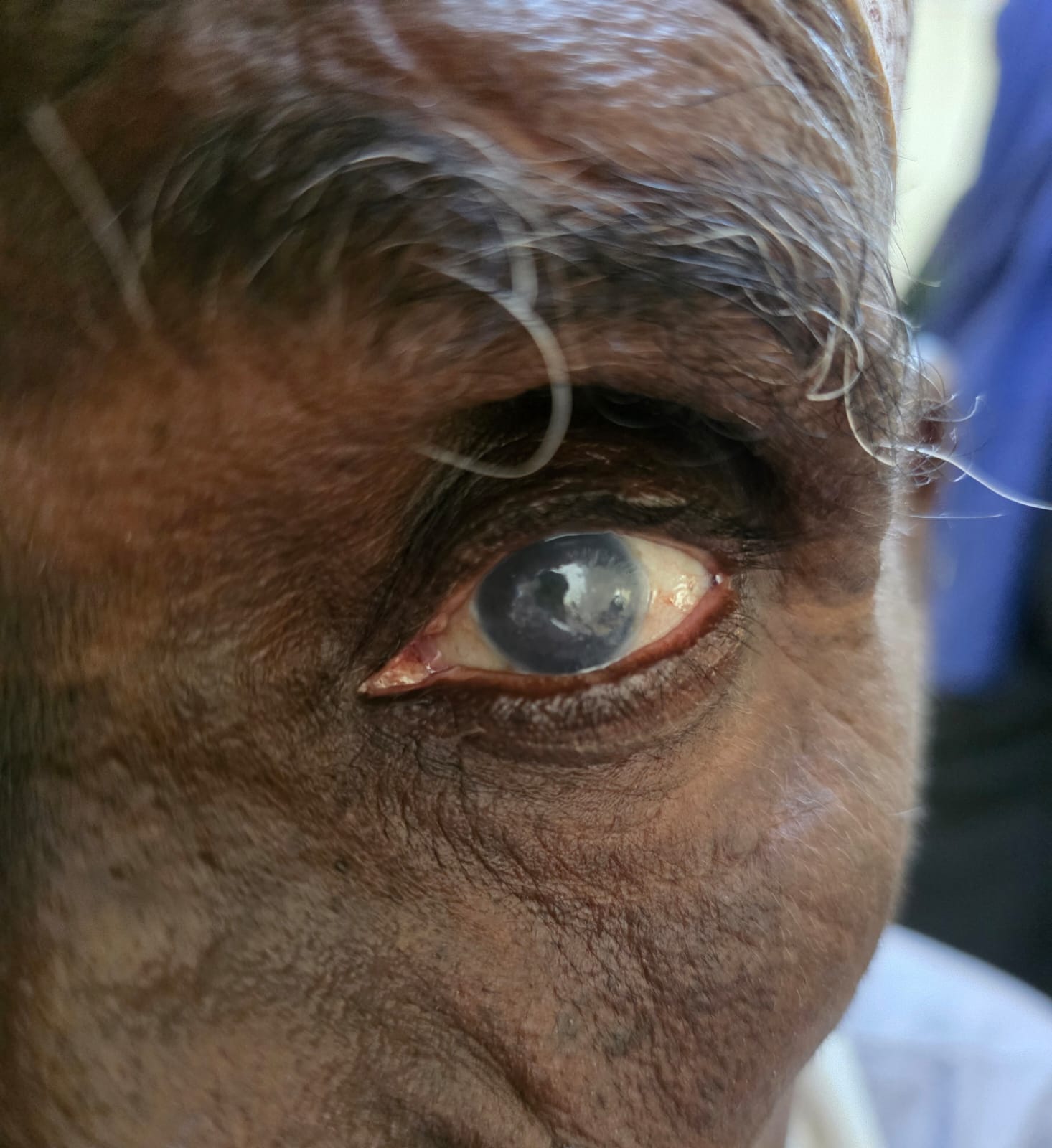 Left Eye Interstitial Keratitis