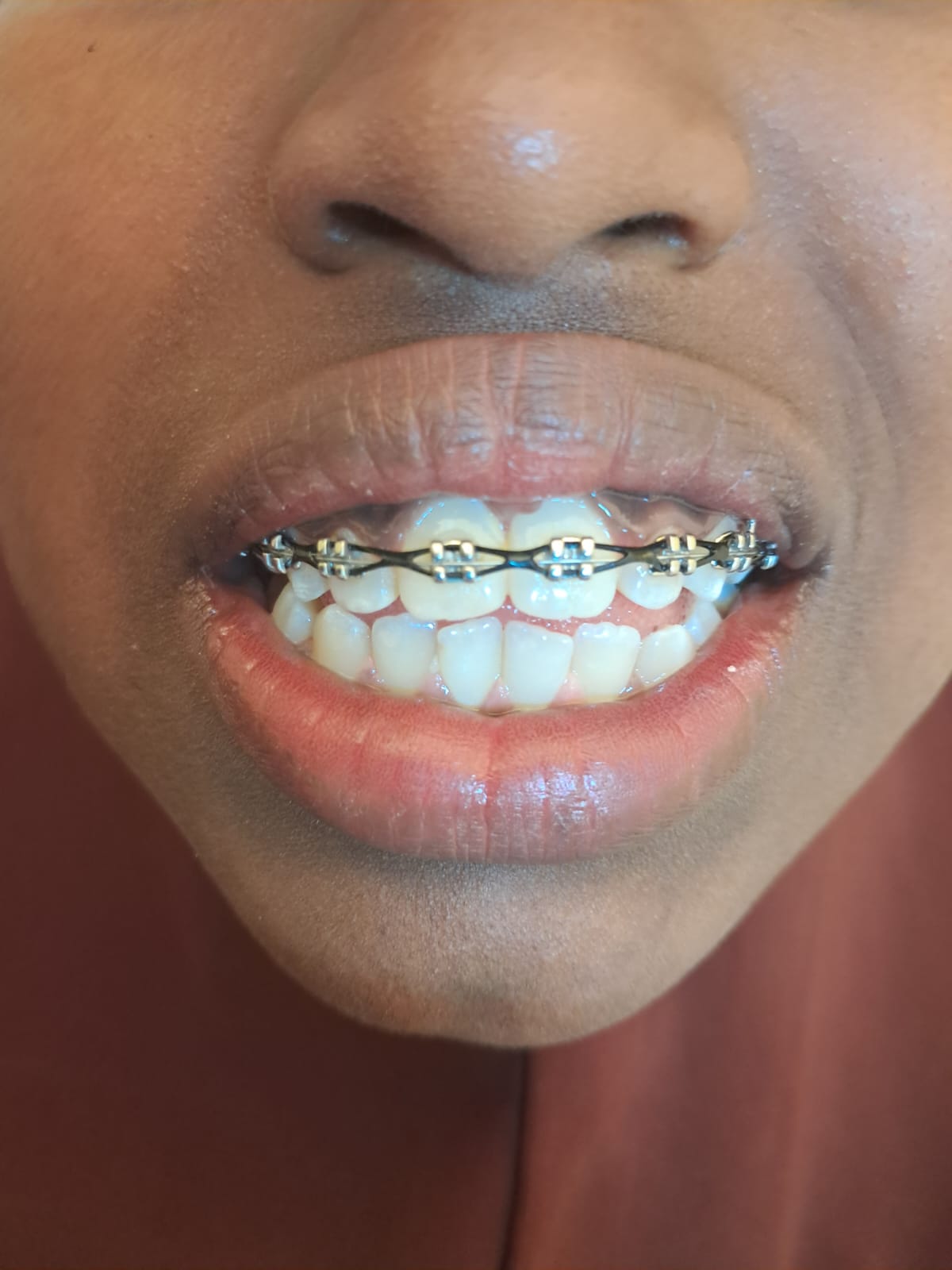 Orthodontic Treatment — After