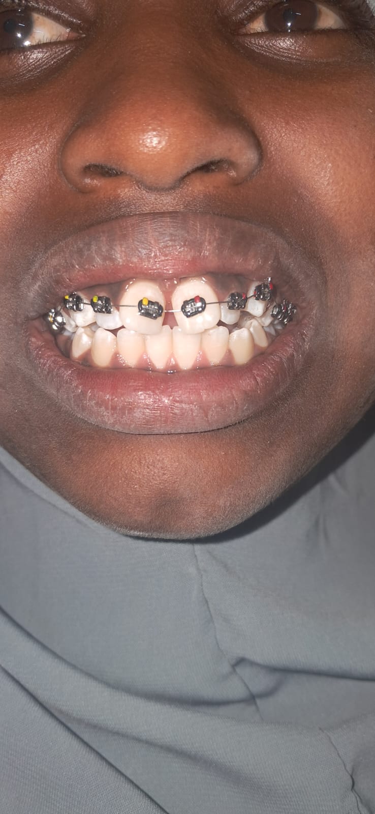 Orthodontic Treatment — Before