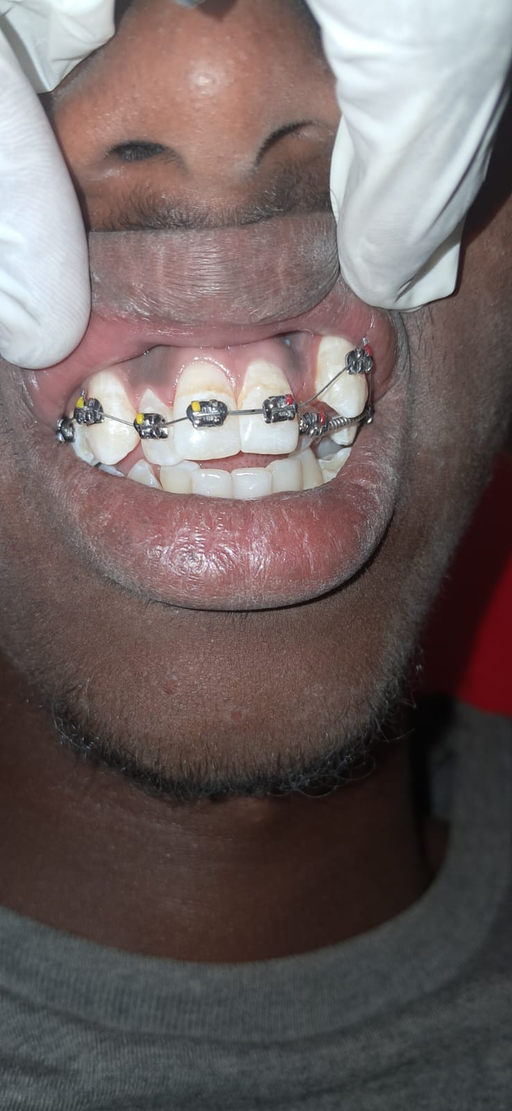 Orthodontic Braces Treatment