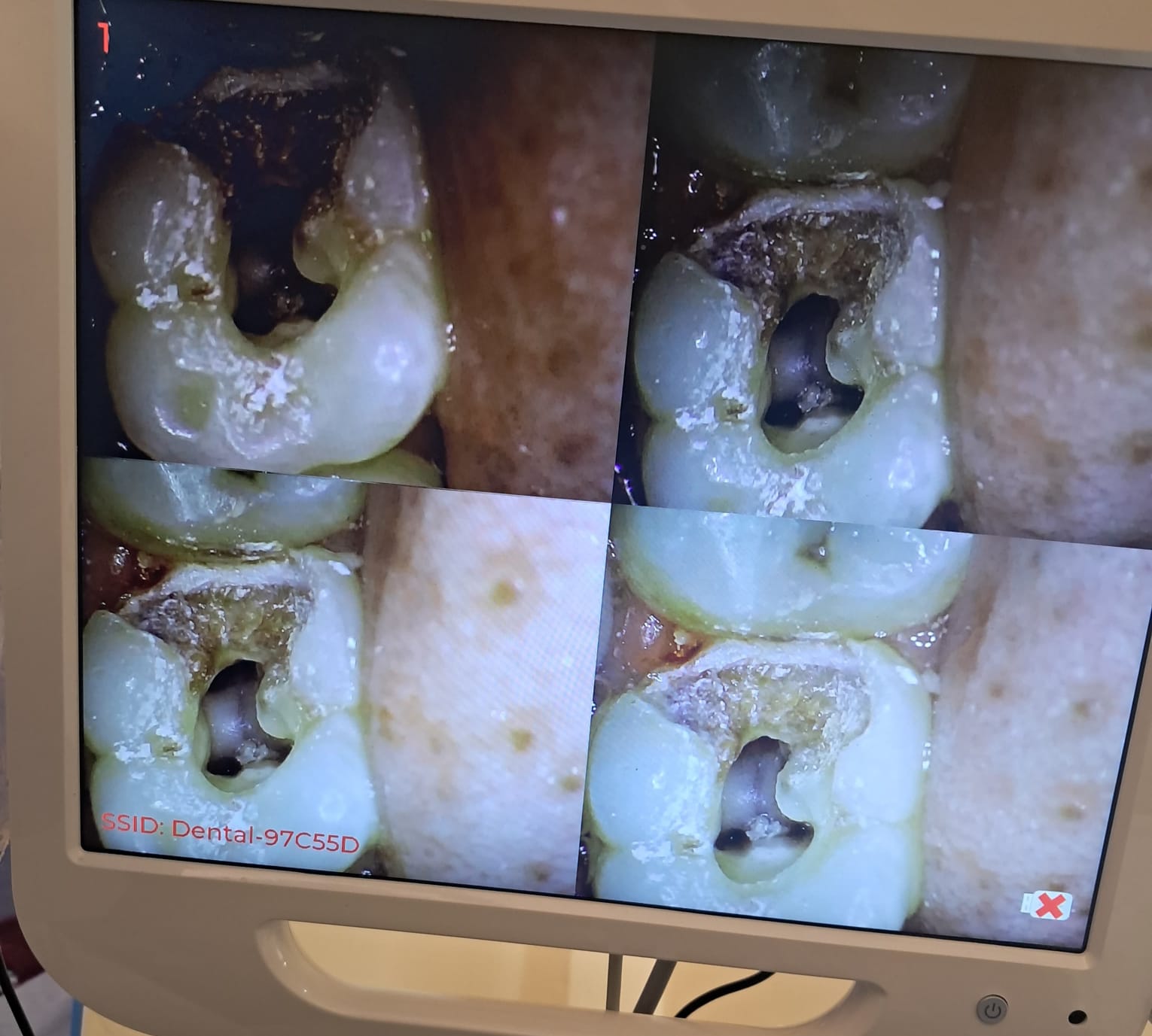 Root Canal X-ray
