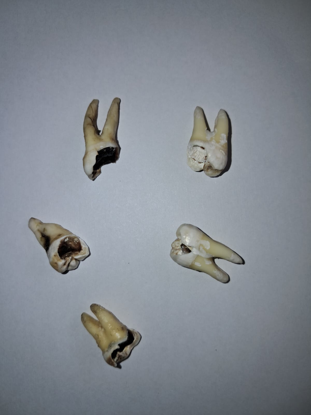 Serial extraction of molars as a result of tooth caries. This arises from poor oral hygiene.
