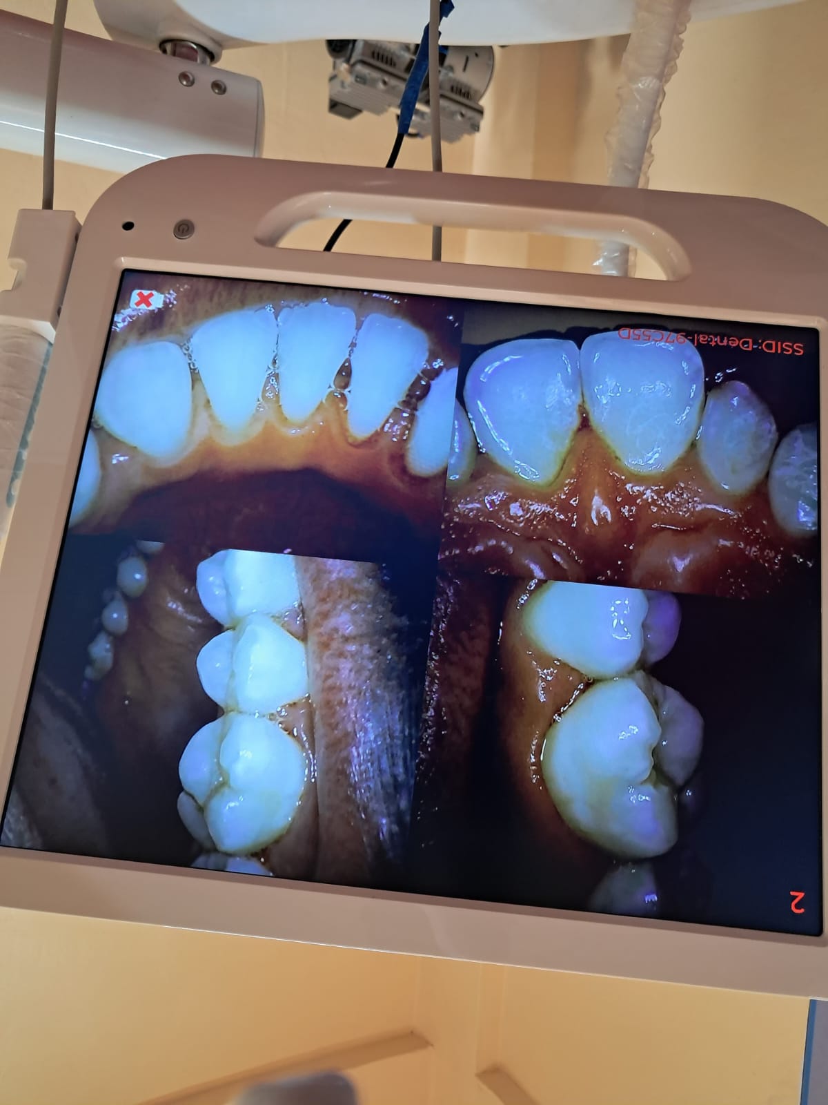 Tooth scaling and polishing. This is the standard procedure of cleaning teeth. It involves removal of plaque that causes gingivitis from above and below the gumline.