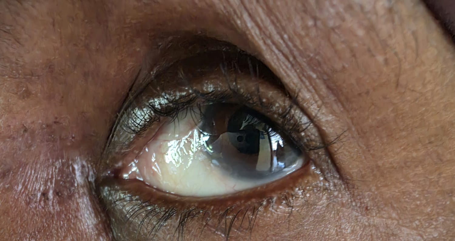Trachomatous Trichiasis / Entropion